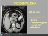 Incidentalomas